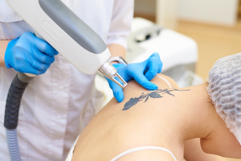 Tattoo removal in a laser cosmetology clinic.