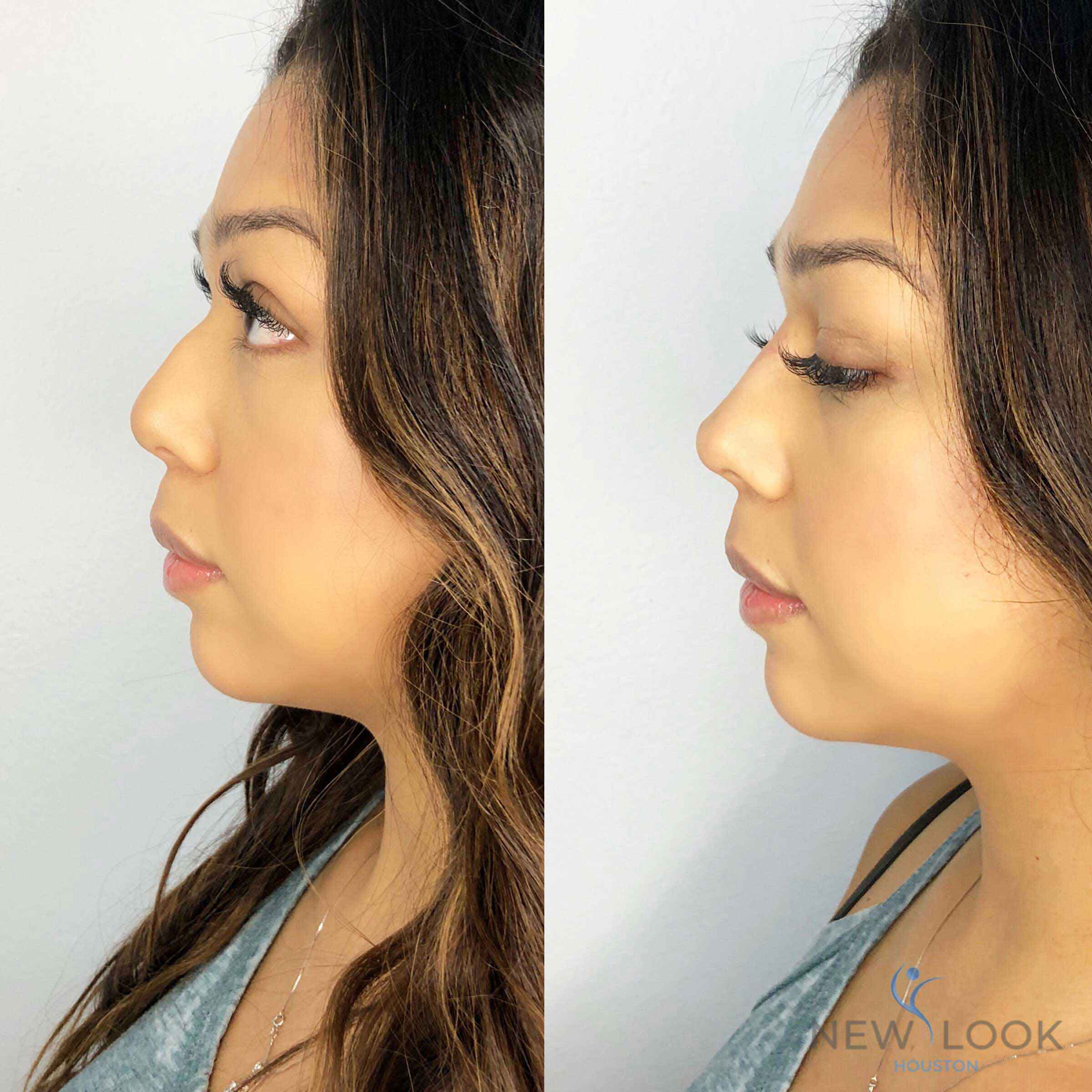 botox-filler-before-after-injectables-7 botox-filler-before-after-injectables-7