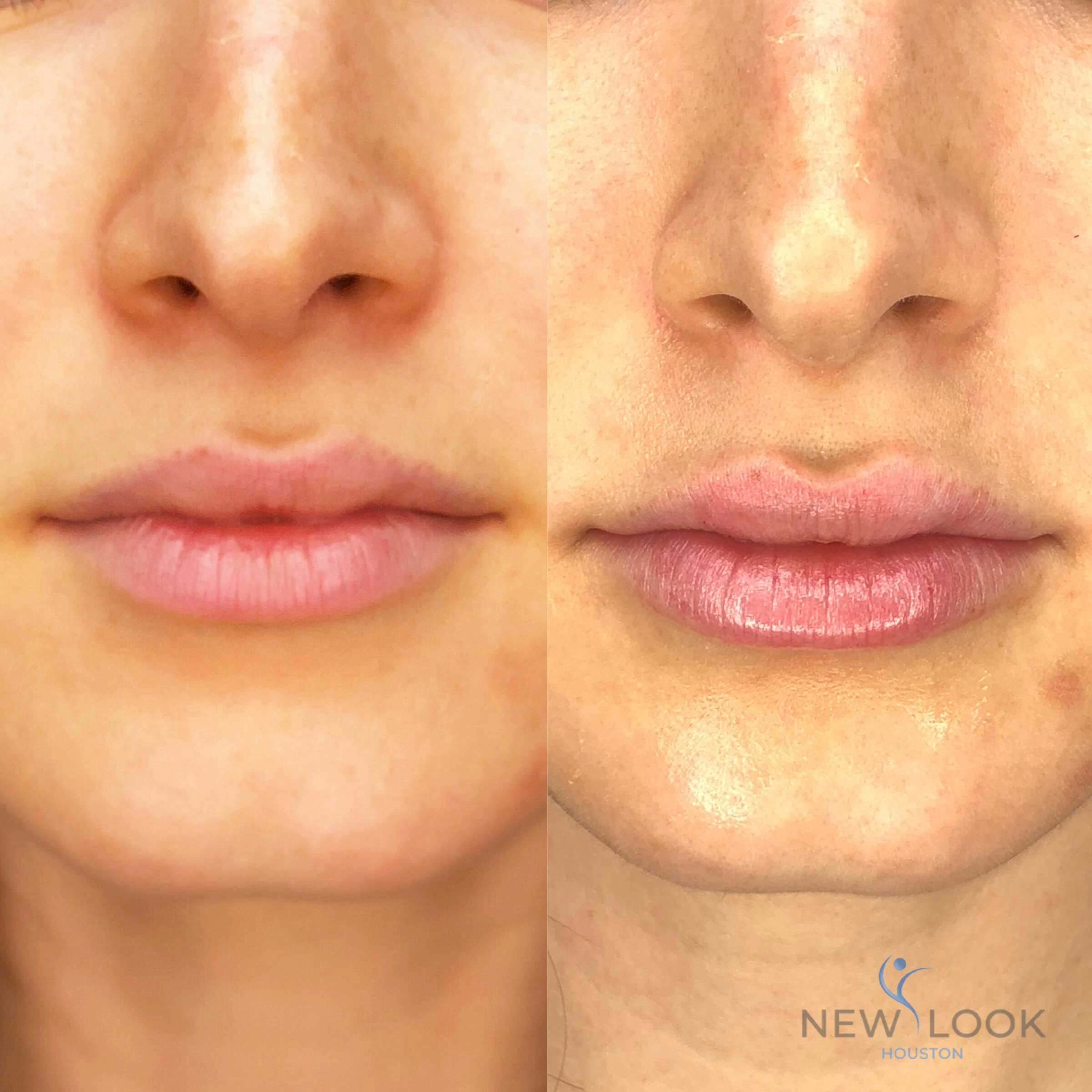 botox-filler-before-after-injectables-8 botox-filler-before-after-injectables-8