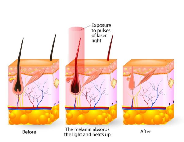 Laser Hair Removal Near Me