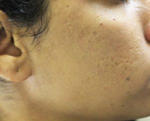 microneedling-acnescars-after
