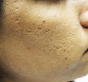 microneedling-acnescars-before
