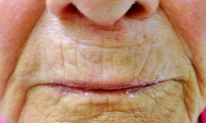 microneedling-wrinklesafter After one Microneedling treatment. a visible reduction in fine lines