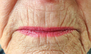 Fine lines around the mouth before treatment