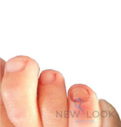 Toenail after laser fungus removal