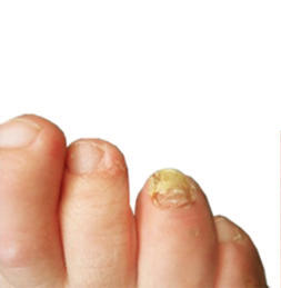 Toenail with fungus