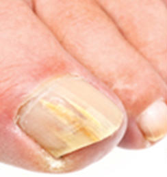 Toenail Fungus