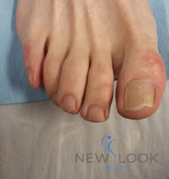 dirty toenail fungus