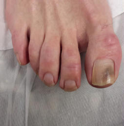 nail fungus